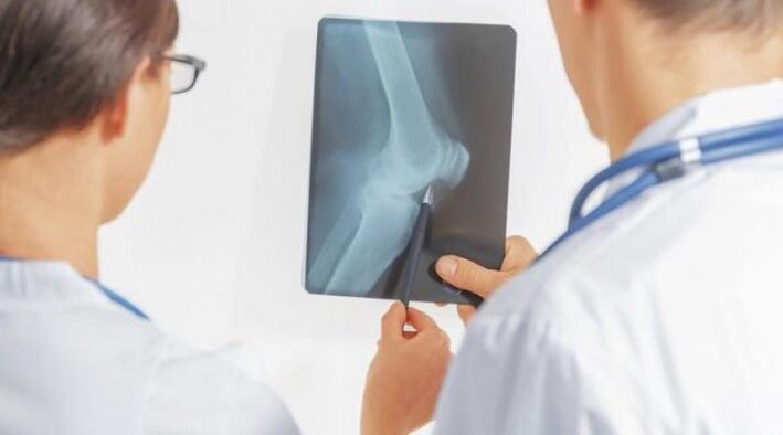 After the necessary diagnosis of arthrosis of the knee joint, doctors prescribe complex treatment