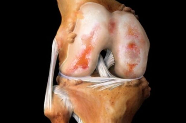 Destruction of the knee joint due to arthrosis – a common pathology of the musculoskeletal system