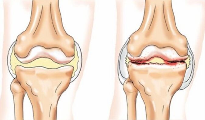 Differences in arthritis and arthrosis