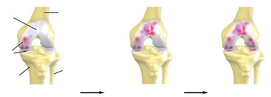 Stadiums of arthrosis