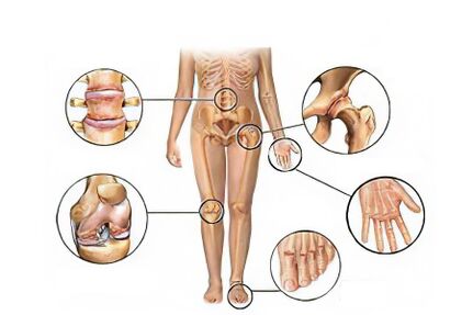 Types of osteoarthritis