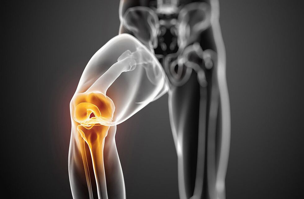 Arthrosis of the knee joint