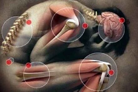 Arthrosis