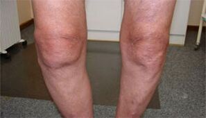 Symptoms of osteoarthritis