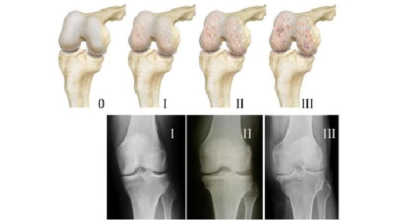 Stages of arthrosis of the knee joint on x-ray