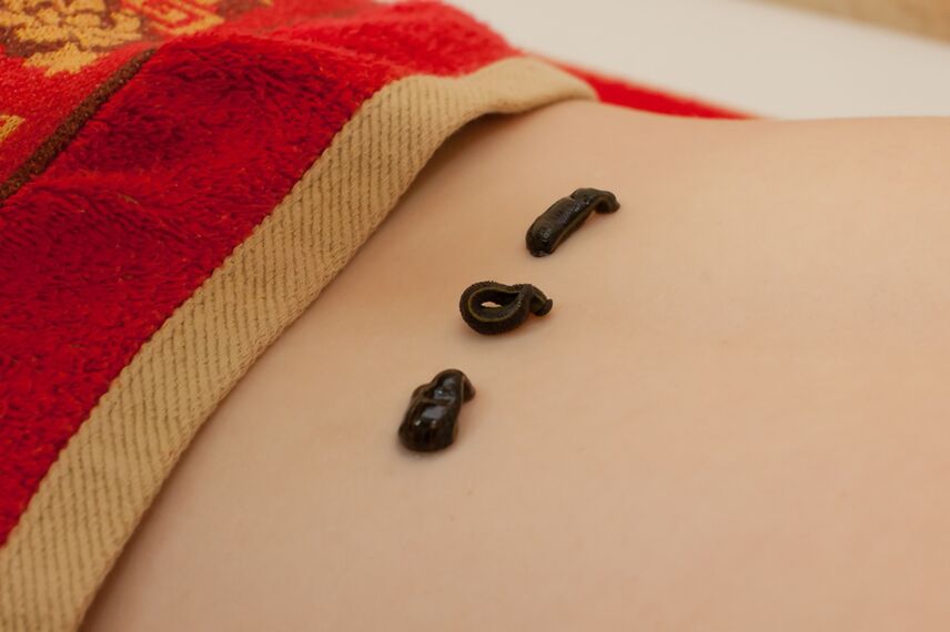 Leeches on the lower back for osteochondrosis