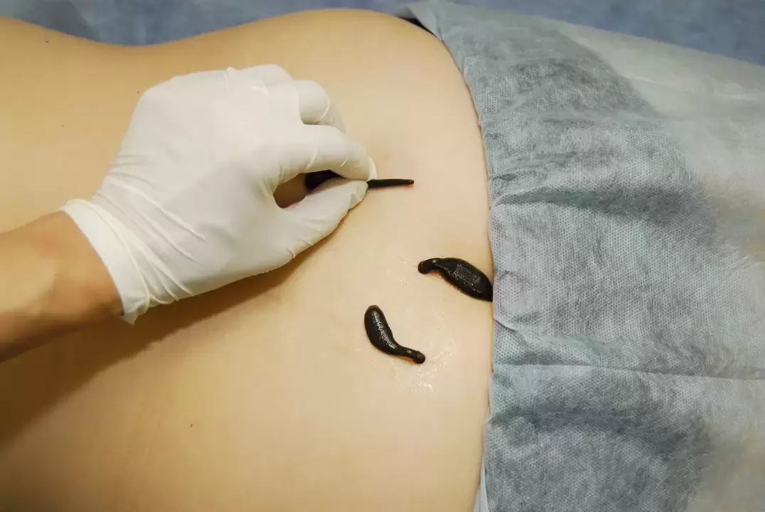 Placement of leeches for lumbar osteochondrosis