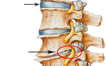 Stages of development of cervical osteochondrosis