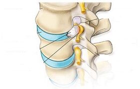 Main symptoms of cervical osteochondrosis