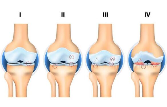 Developmental stages of osteoarthritis