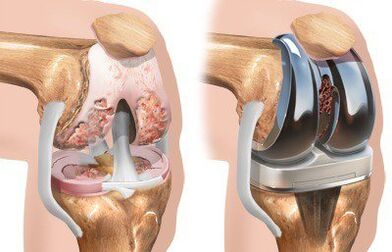 Arthroplasty of the knee joint in gonarthrosis